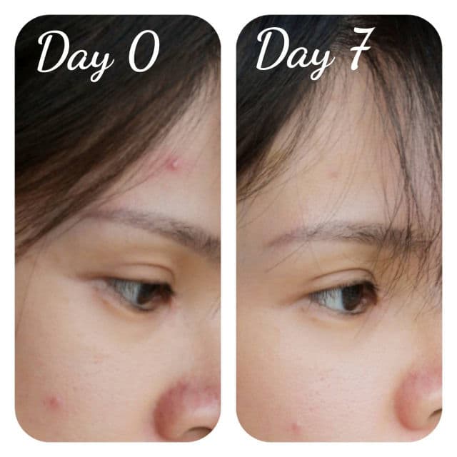 Jumiso AC Cure No Pain No Gain Spot Cream review photo by bubblyvivi