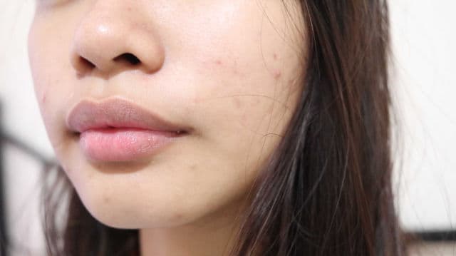 Hello Glow Blemish Miracle Set - Cream review photo by Lemonie