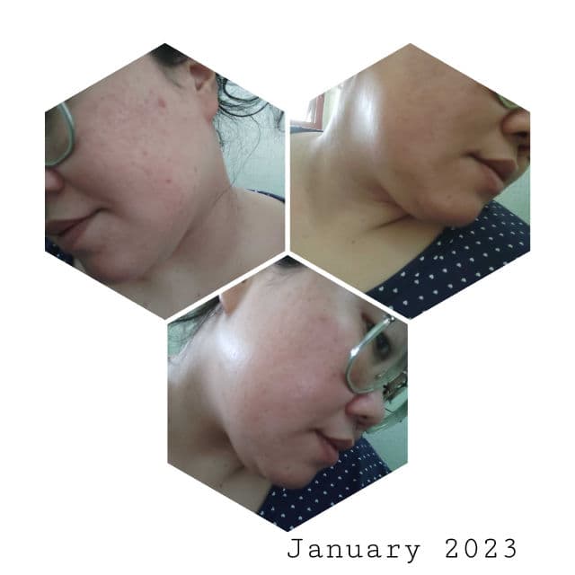 COSRX AC Collection Blemish Spot Clearing Serum review photo by Jamalia