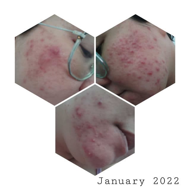 COSRX AC Collection Blemish Spot Clearing Serum review photo by Jamalia