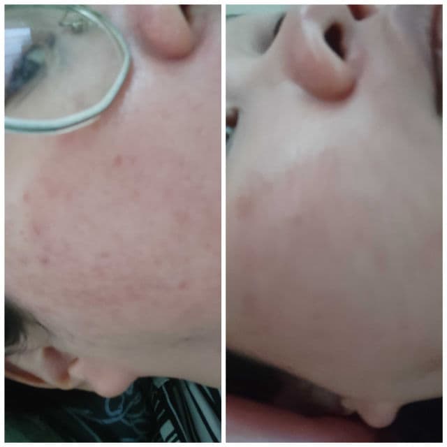 SKINMADE Azelaic Acid + Salicylic Acid Serum review photo by Jamalia