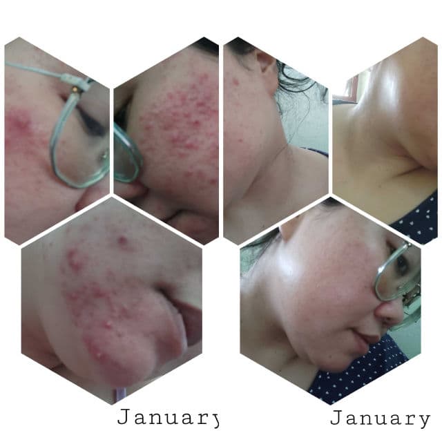 COSRX AC Collection Blemish Spot Clearing Serum review photo by Jamalia