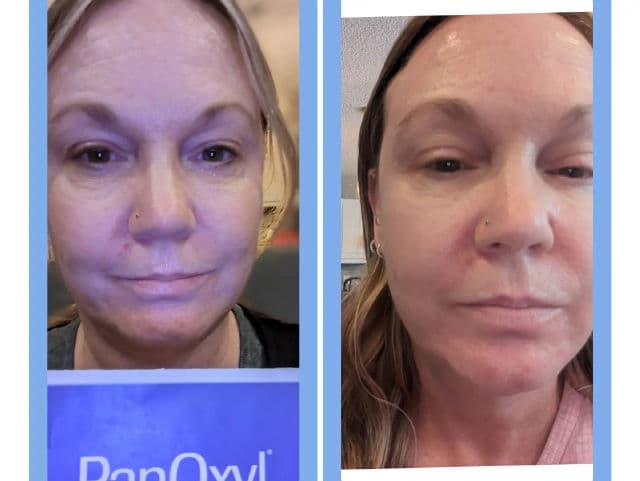 PanOxyl PM Overnight Spot Patches review photo by remedyforbeauty