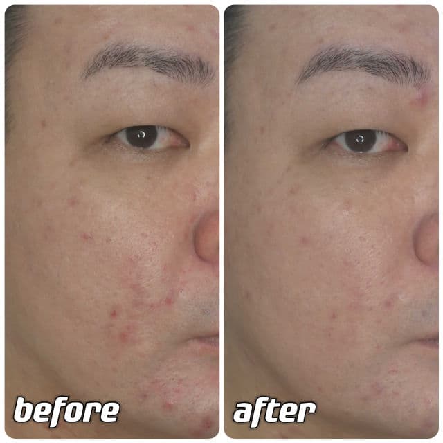 Aestura Atobarrier 365 Lotion review photo by danielwonderland