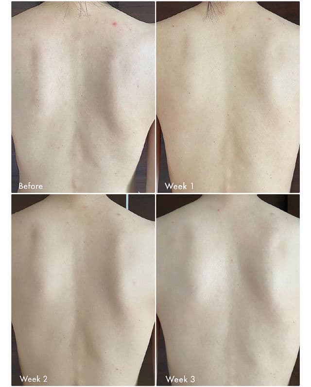 TIAM Anti Blemish Body Lotion Back & Chest review photo by jacyang