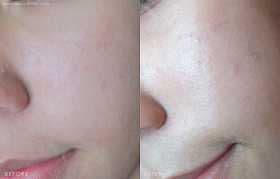 HaruHaru WONDER Soothing Mask review photo by WondaDonda