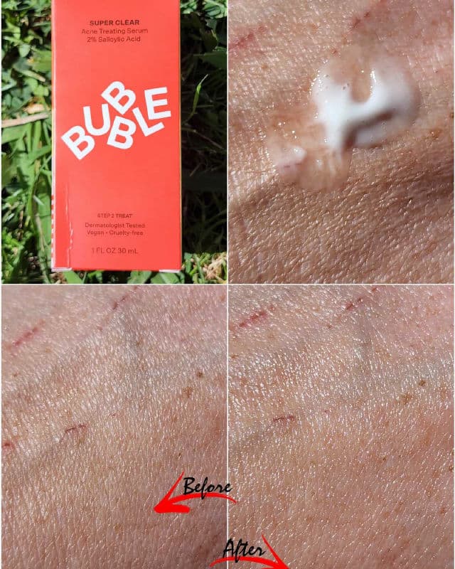 Bubble Super Clear Acne Treating Serum review photo by Researching4Beauty
