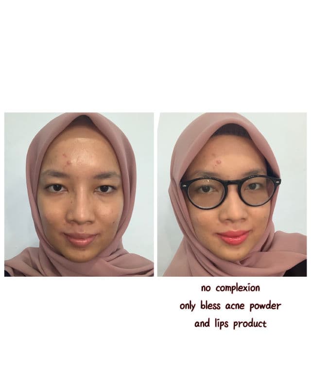 Bless Acne Face Powder  review photo by Siitha