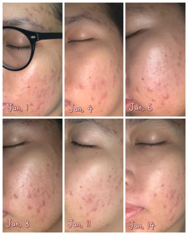 Jumiso AC Cure No Pain No Gain Spot Cream review photo by Siitha