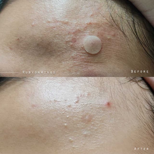 NINELESS A-Control 10% Azelaic Acid Serum review photo by RubyonWings