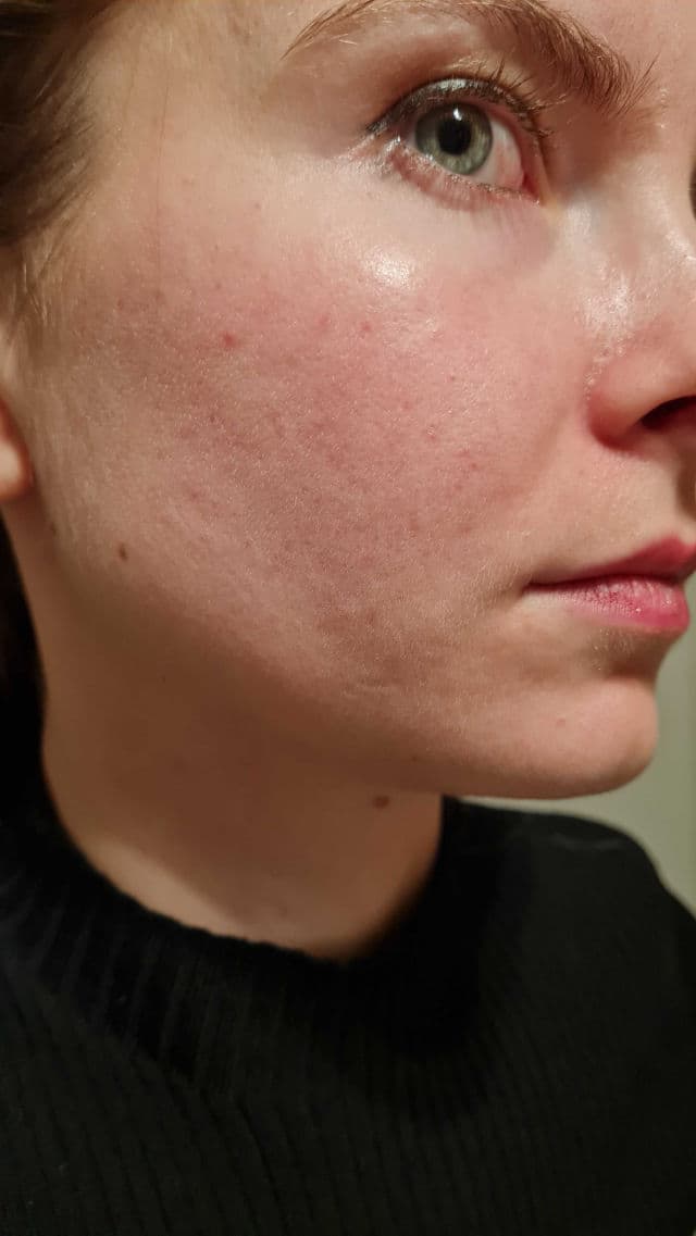 Soolantra 10 Mg/G Cream review photo by sensitivejean