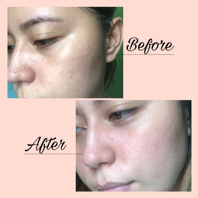 Niacinamide Zinc Serum product review