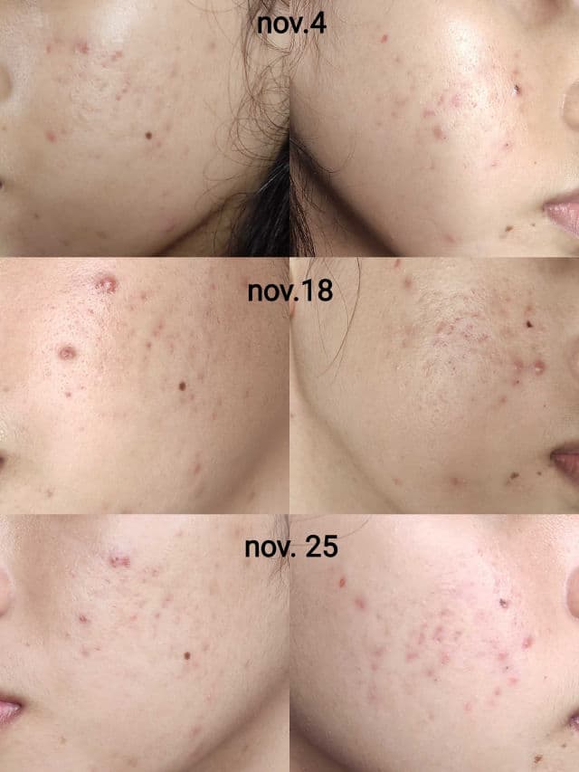 Cathy Doll Acne Solution Serum Foam Cleanser review photo by mariakristine