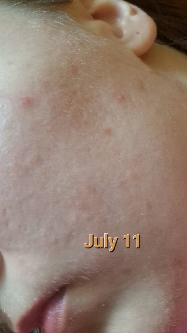 Centella Calming AC Spot Cream product review