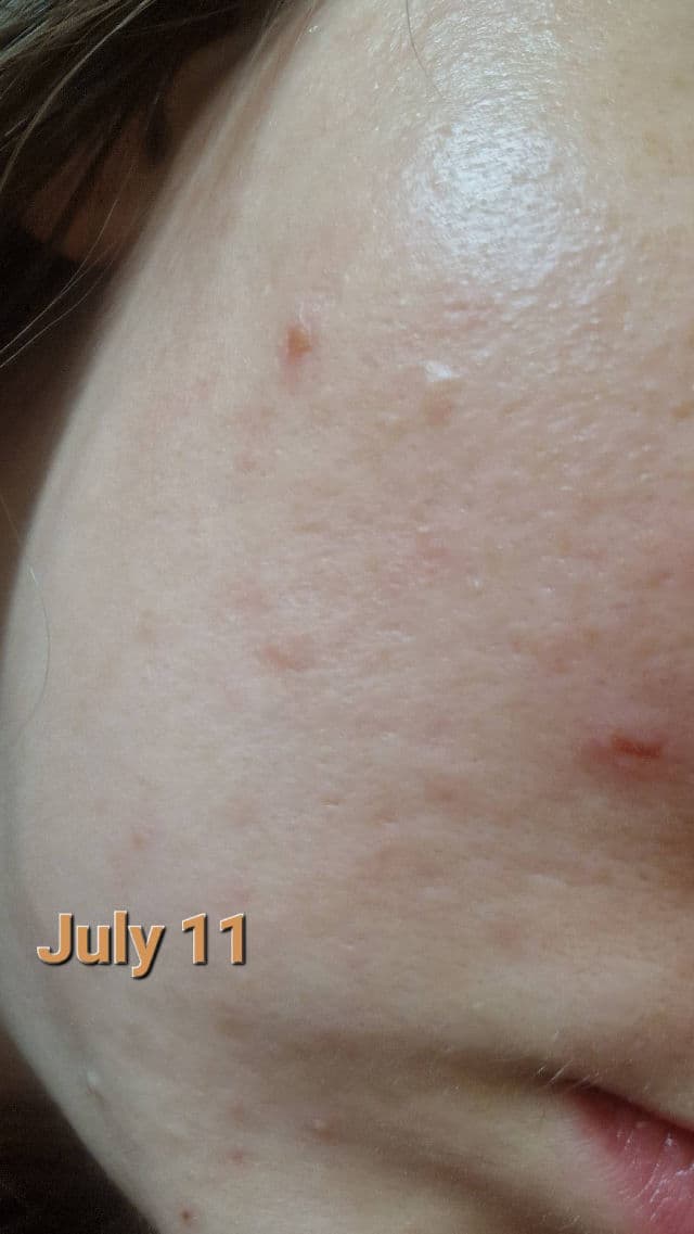 Centella Calming AC Spot Cream product review