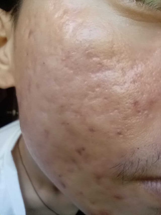Lanbena TCM Scar and Acne Mark Removal Gel Ointment review photo by Tieny