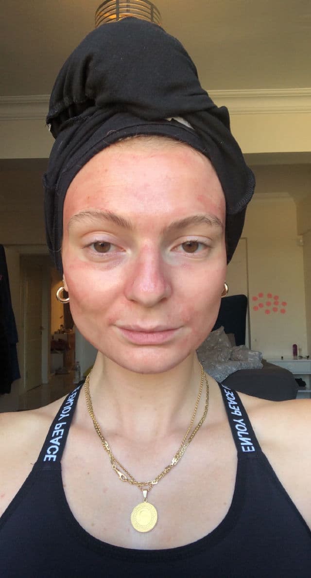 The Purest Solutions Exfoliating Facial Peeling AHA %10 + BHA %2 review photo by AlissonK