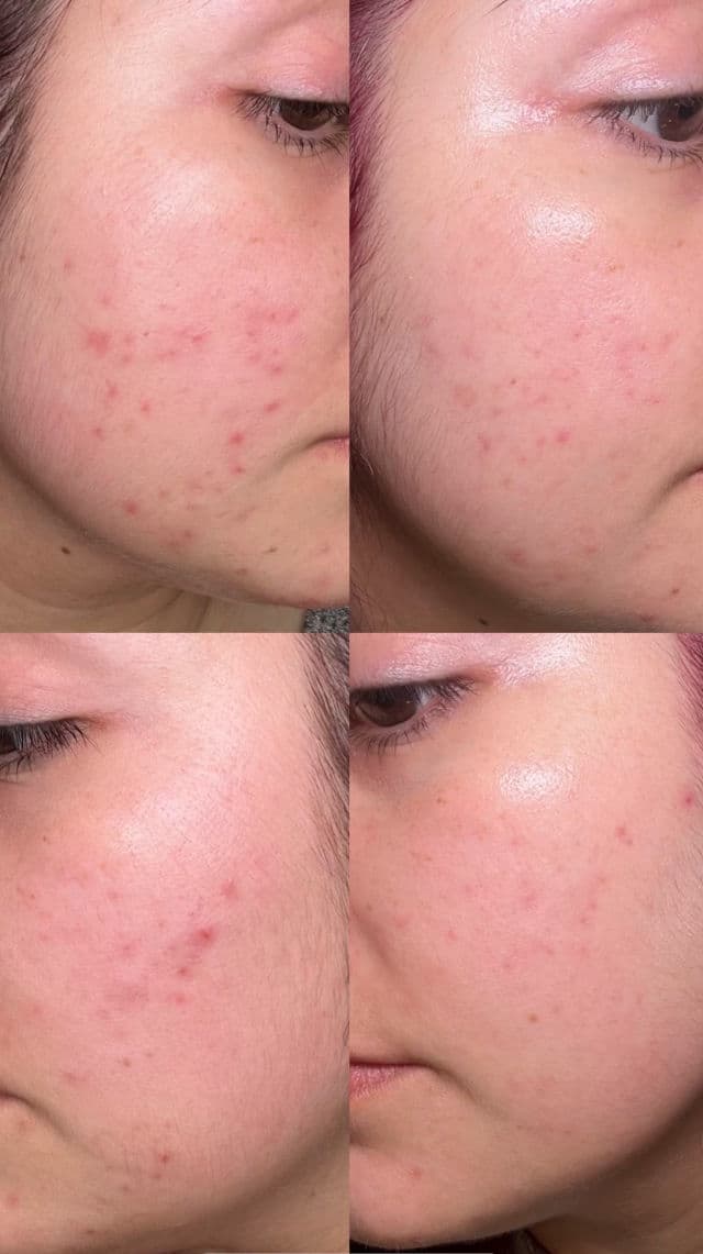 CIRACLE Red Spot Cream review photo by Ninamg