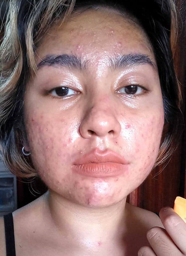 +ful Niacinamide 10% Serum (Anti-Blemish Brightening Treatment) review photo by Renegade