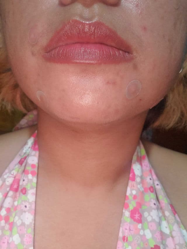 ELIZAVECCA Witch Piggy Hell Pore Blemish Spot Patch review photo by Renegade