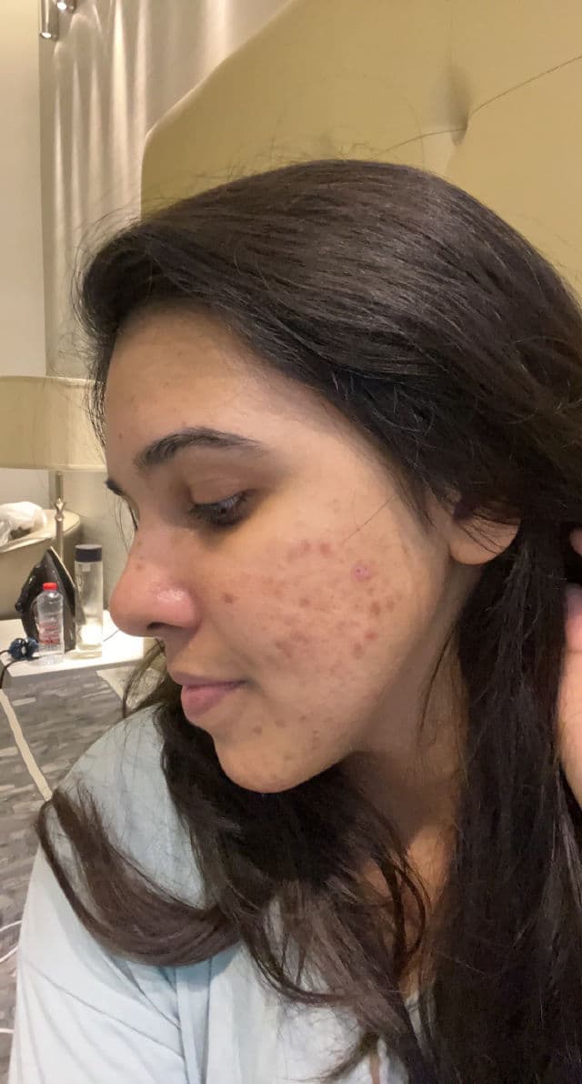 Minimalist Tranexamic 3% + HPA review photo by prarthana2100