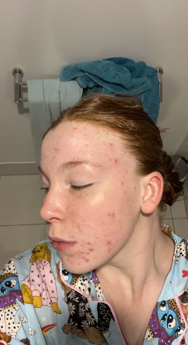 Hero Cosmetics Clarifying Prebiotic Moisturizer review photo by Lizzieeeee