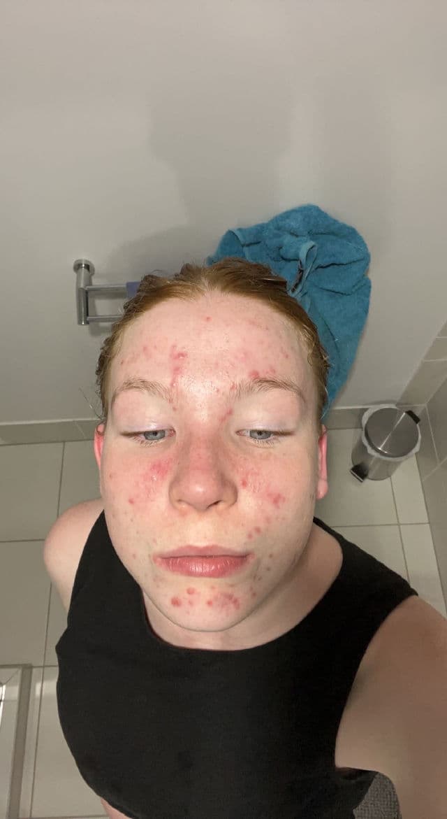 Hero Cosmetics Clarifying Prebiotic Moisturizer review photo by Lizzieeeee
