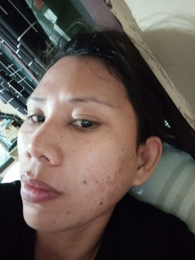 Hello Glow Blemish Miracle Set - Cream review photo by PickyLenais