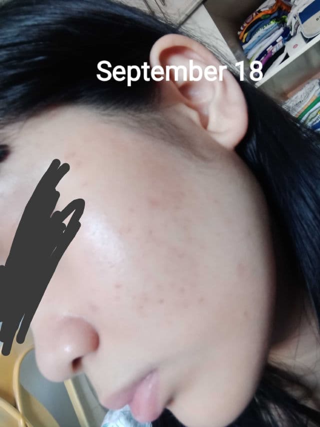Ellana Cosmetics Clear Skin+ Clarifying Serum With 10% Azelaic Acid (Azeclair) review photo by AriArya00
