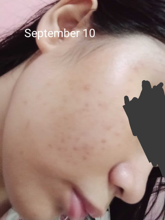 Ellana Cosmetics Clear Skin+ Clarifying Serum With 10% Azelaic Acid (Azeclair) review photo by AriArya00