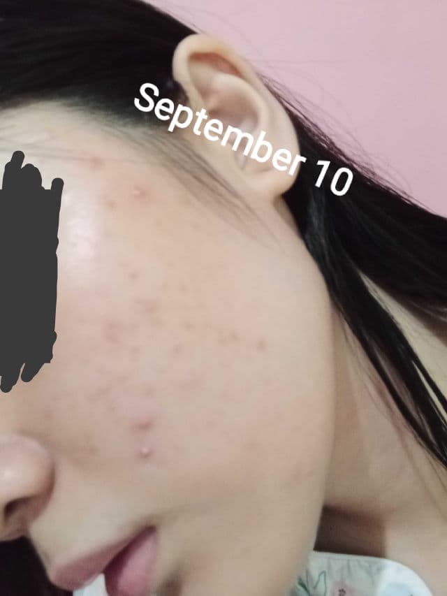 Ellana Cosmetics Clear Skin+ Clarifying Serum With 10% Azelaic Acid (Azeclair) review photo by AriArya00