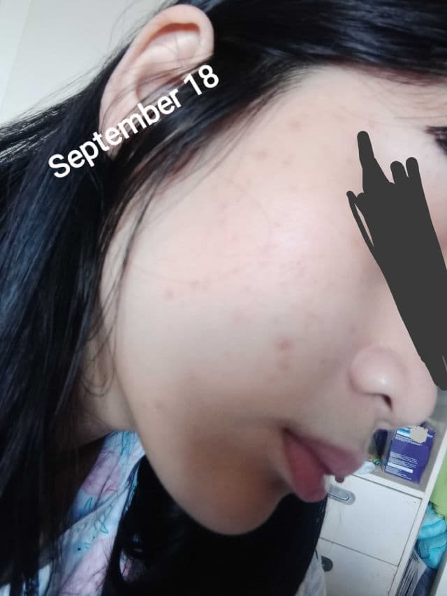 Ellana Cosmetics Clear Skin+ Clarifying Serum With 10% Azelaic Acid (Azeclair) review photo by AriArya00