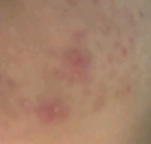 The Creme Shop Cotton Candy Skin - Hydrocolloid Acne Patches review photo by Marilynn