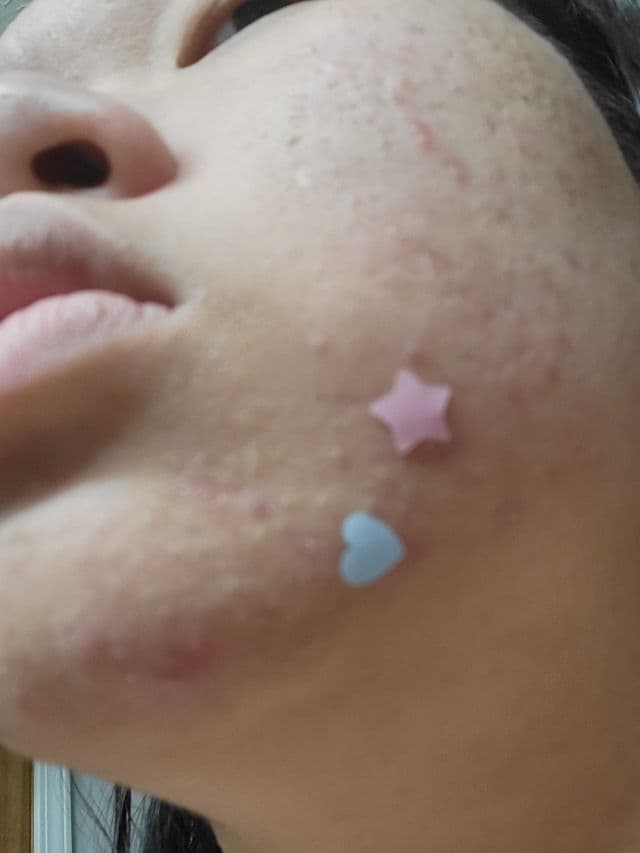 The Creme Shop Cotton Candy Skin - Hydrocolloid Acne Patches review photo by Marilynn