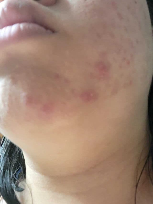 The Creme Shop Cotton Candy Skin - Hydrocolloid Acne Patches review photo by Marilynn