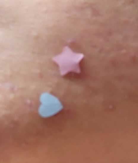 The Creme Shop Cotton Candy Skin - Hydrocolloid Acne Patches review photo by Marilynn