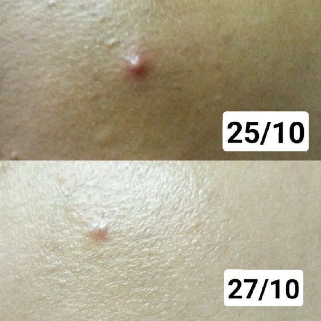 The Raw. Acne Spot Drying Solution review photo by gojeshani