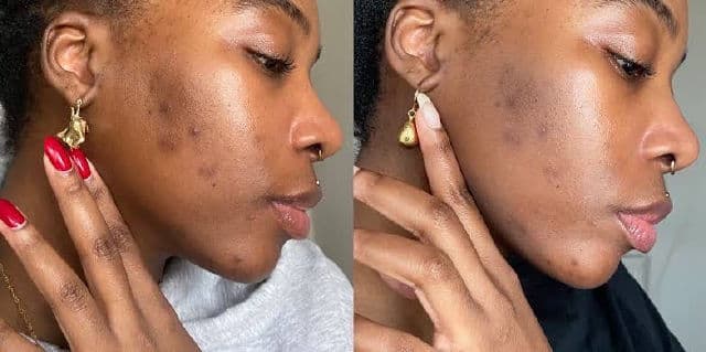 The Inkey List Tranexamic Acid Serum review photo by Picky36101