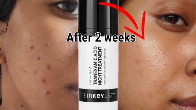 The Inkey List Tranexamic Acid Serum review photo by Picky36101