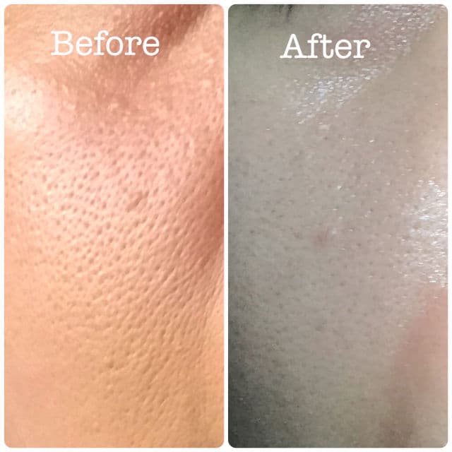 Rovectin [Discontinued] Clean LHA Blemish Ampoule review photo by mydeardanie22