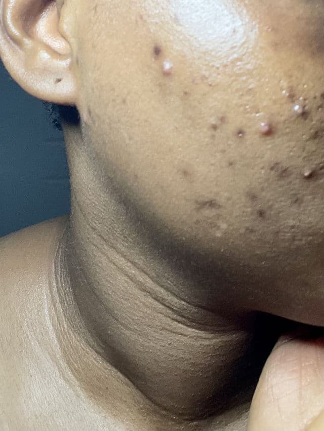 Paula's Choice Skin Perfecting 2% BHA Liquid Exfoliant review photo by DearDami