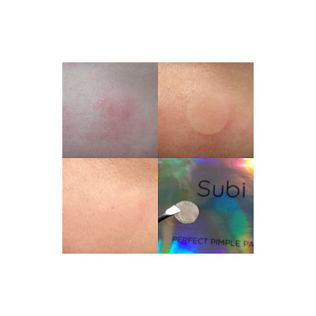 Subi Perfect Pimple Patch review photo by alexandraskrupnikova