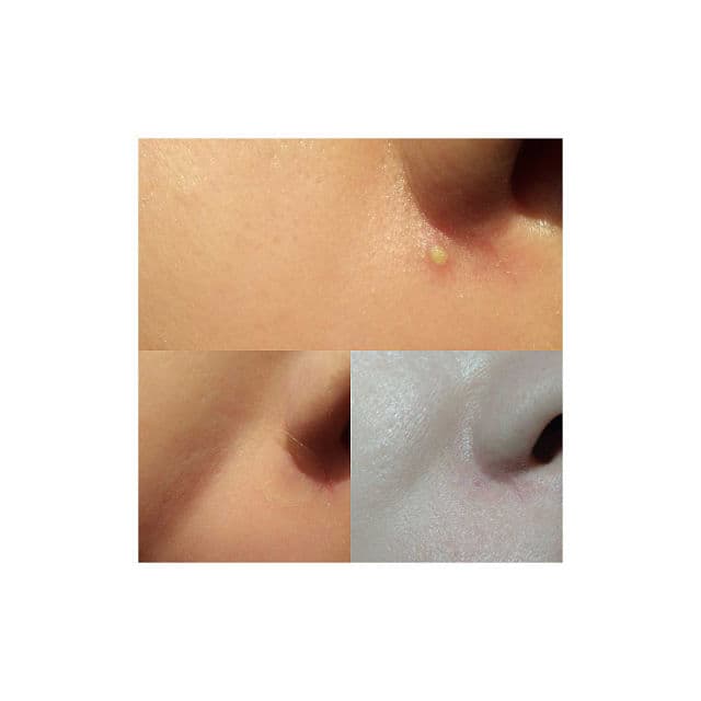 Subi Perfect Pimple Patch review photo by alexandraskrupnikova