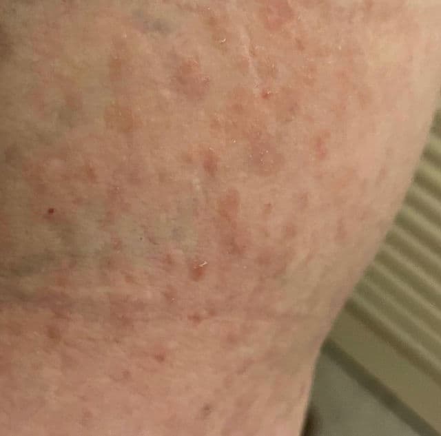 Me+ Salicylic Acid Body Gel Cream review photo by sharon329