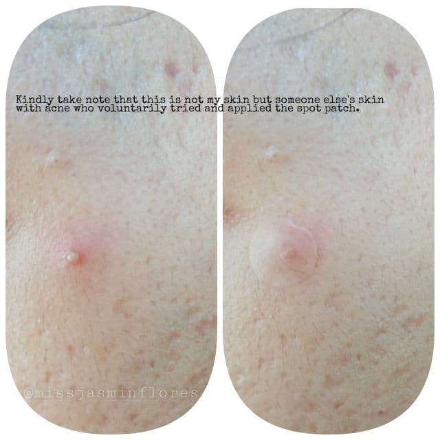Cica Clear Spot Patch product review