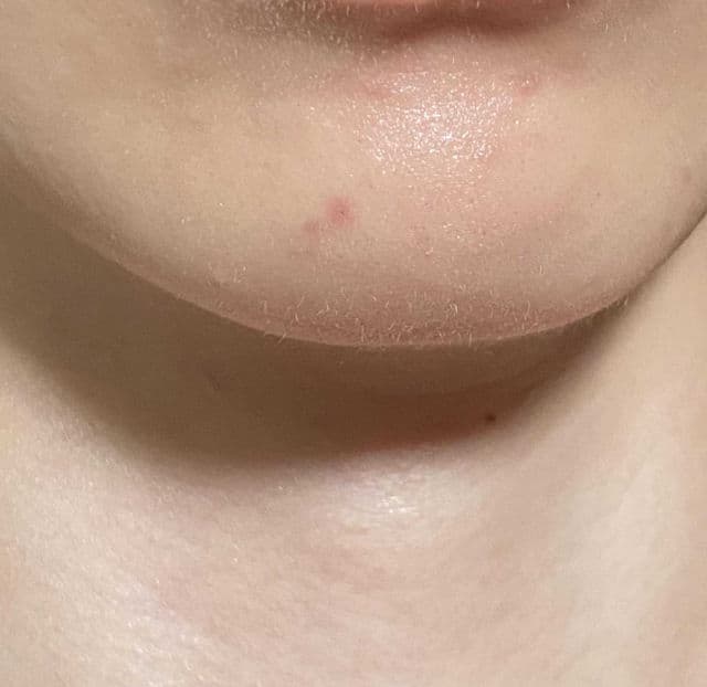 Ellana Cosmetics Calm Down AHA/BHA Acne Spot Gel review photo by PickyJeom