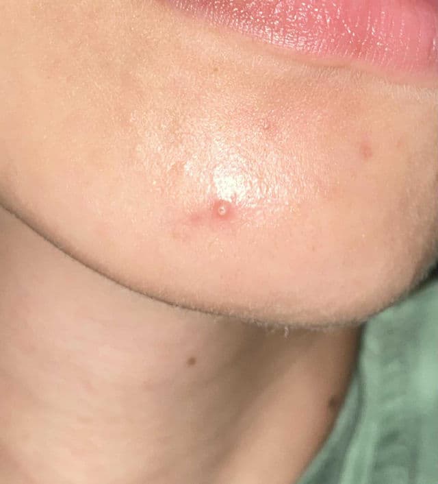 Ellana Cosmetics Calm Down AHA/BHA Acne Spot Gel review photo by PickyJeom