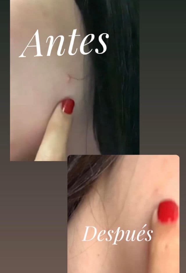 Succinic Acid Acne Treatment product review
