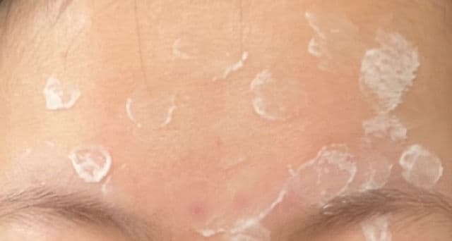 Clean & Clear Persa-Gel 10, Maximum Strength review photo by nicolescorner