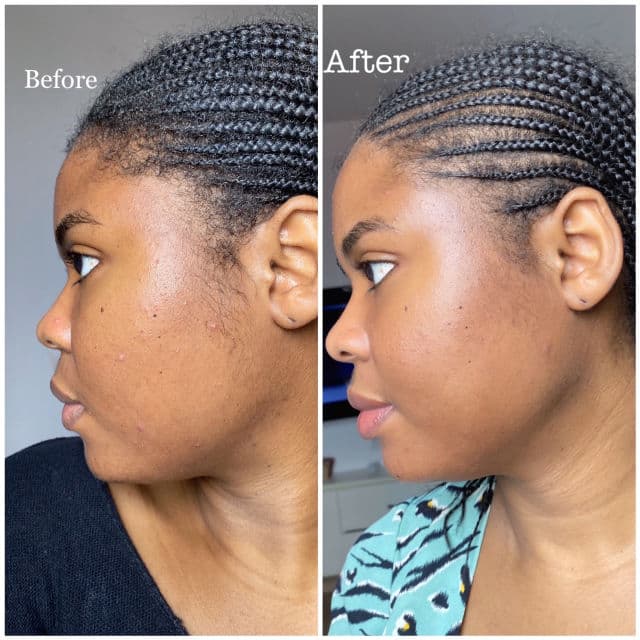 NINELESS A-Control 10% Azelaic Acid Serum review photo by marisrieskin